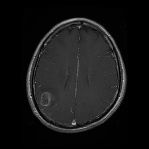 glioma