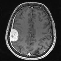 meningioma